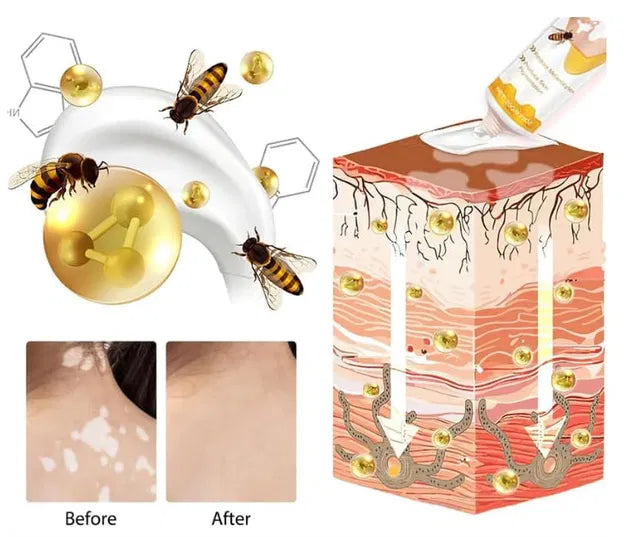 Bee Venom Vitigo Correcting Cream - (Pack of 2)